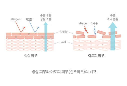 정상피부와 아토피피부(건조피부)의 비교