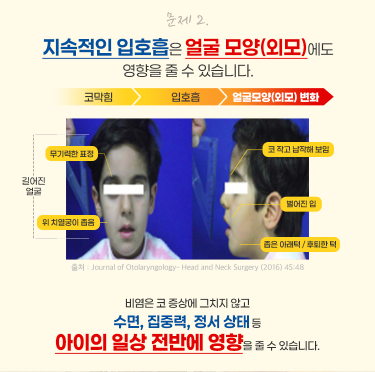 문제2 지속적인 입호흡은 얼굴 모양(외모)에도 영향을 줄 수 있습니다.